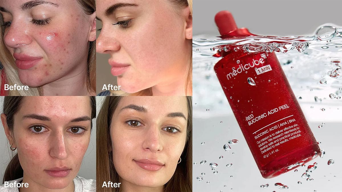 پوستی پاک با قدرت سوکسینیک اسید