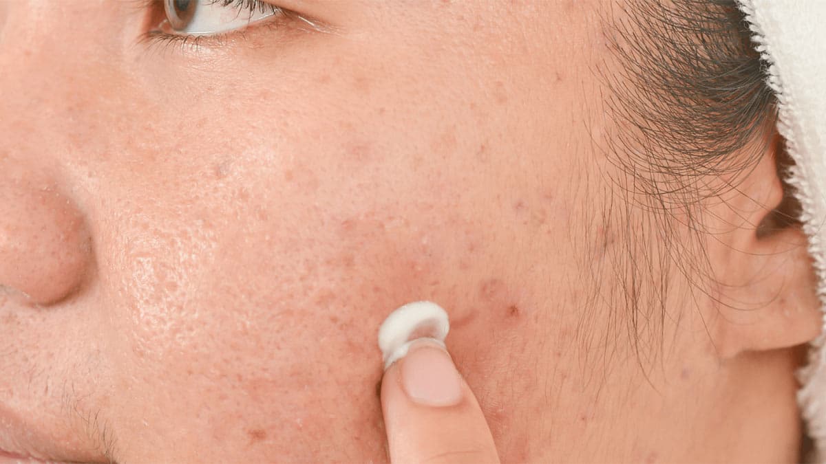 روتین روزانه مراقبت از پوست چرب و مستعد جوش