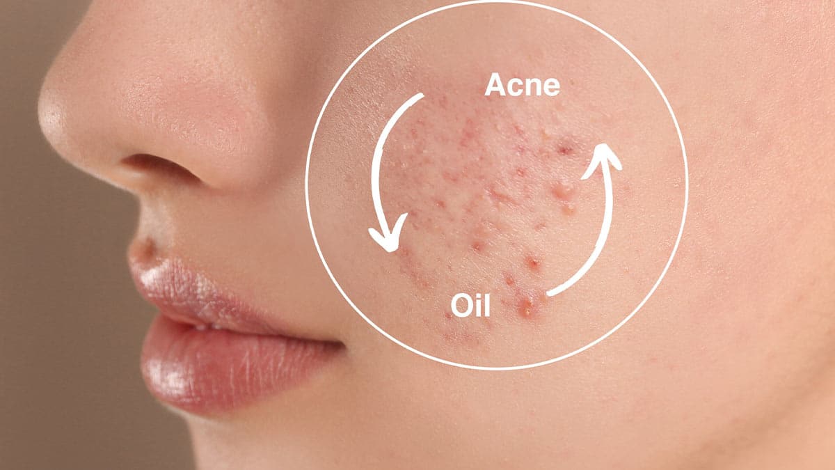 شناخت پوست چرب و مستعد جوش